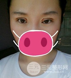 北京全切雙眼皮手術(shù)真實(shí)案例，果對比圖