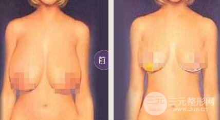 巨大乳房縮小多少錢？成好嗎?巨大乳房縮小對(duì)比圖