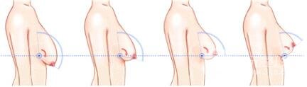 巨大乳房縮小手術(shù)后遺癥有哪些?多少錢? 巨大乳房縮小果圖