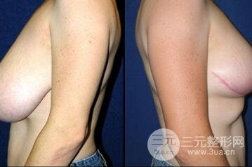 巨大乳房縮小手術(shù)后遺癥有哪些?多少錢? 巨大乳房縮小果圖
