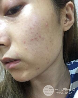 水光補水嫩膚果圖前后對比和恢復過程真實案例分享