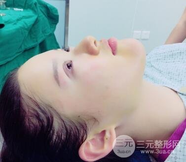 三點(diǎn)定位雙眼皮整形恢復(fù)圖案例