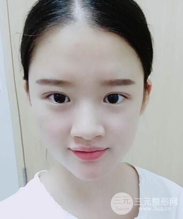 三點(diǎn)定位雙眼皮整形恢復(fù)圖案例
