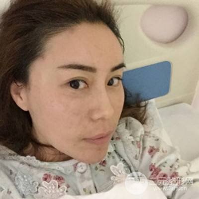 武漢美侖陳遠海自體脂肪填充全臉案例，附上前后對比圖片