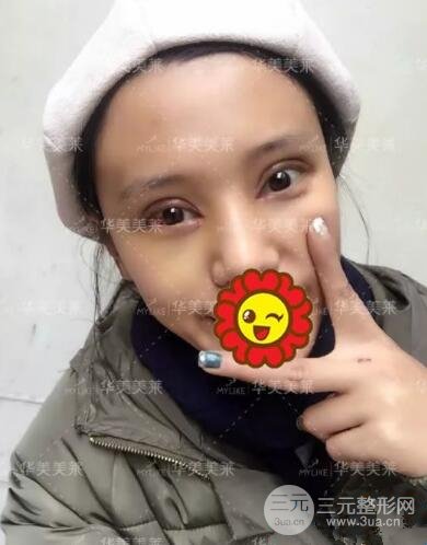 昆明華美楊繼紅全切雙眼皮怎么樣？真實(shí)案例圖片分享~