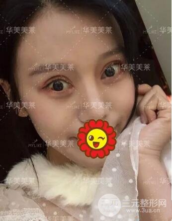 昆明華美楊繼紅全切雙眼皮怎么樣？真實(shí)案例圖片分享~