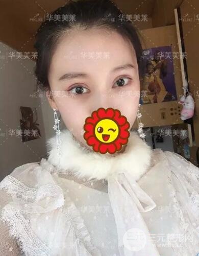 昆明華美楊繼紅全切雙眼皮怎么樣？真實(shí)案例圖片分享~