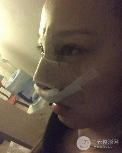 武漢美侖陳遠海假體隆鼻案例，恢復(fù)過程分享~