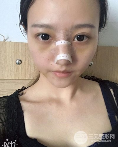 武漢美侖陳遠海假體隆鼻案例，恢復(fù)過程分享~