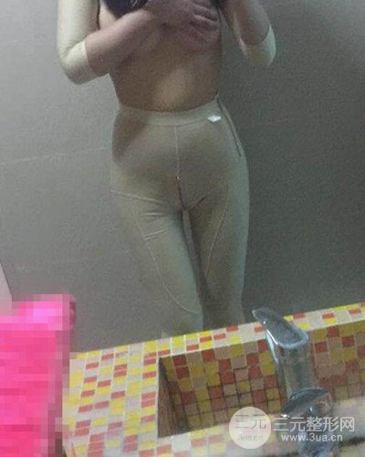 廣州韓妃大腿吸脂案例，恢復(fù)過(guò)程前后對(duì)比圖片分享~