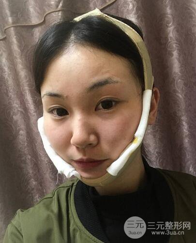 下頜角磨骨整形全過程分享，附上術后恢復照片~