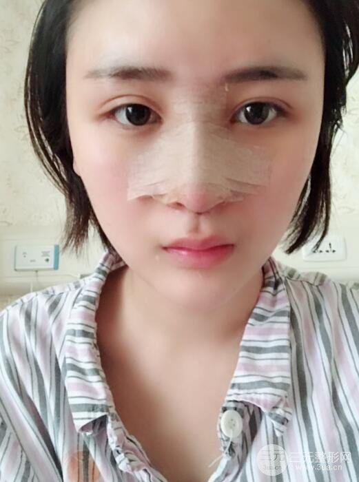 重慶五洲范文亮隆鼻整形案例，前后對比圖分享