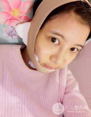 北京吸脂瘦臉真人案例恢復(fù)過程分享，巴掌小臉不是夢