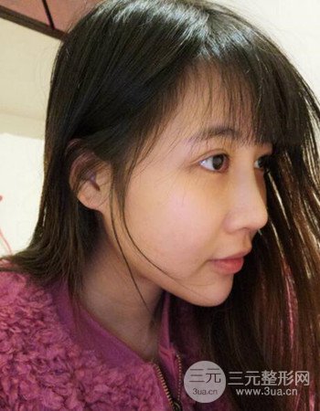 北京吸脂瘦臉真人案例恢復(fù)過程分享，巴掌小臉不是夢