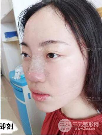 廣州博仕隆鼻失敗修復(fù)案例，前后恢復(fù)過程分享~