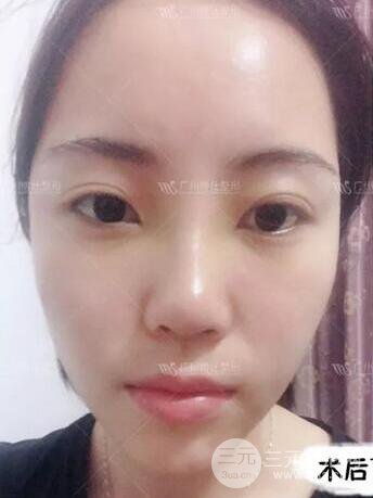 廣州博仕隆鼻失敗修復(fù)案例，前后恢復(fù)過程分享~