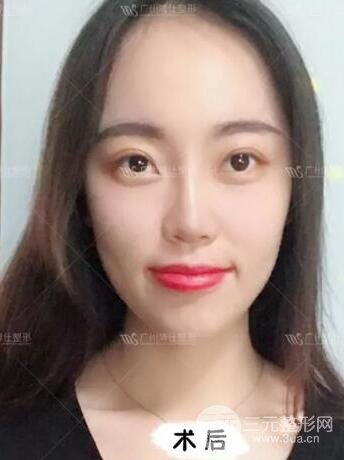廣州博仕隆鼻失敗修復(fù)案例，前后恢復(fù)過程分享~