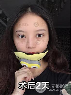 華美紫馨邱偉雙眼皮案例術后7天果圖分享