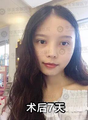 華美紫馨邱偉雙眼皮案例術后7天果圖分享