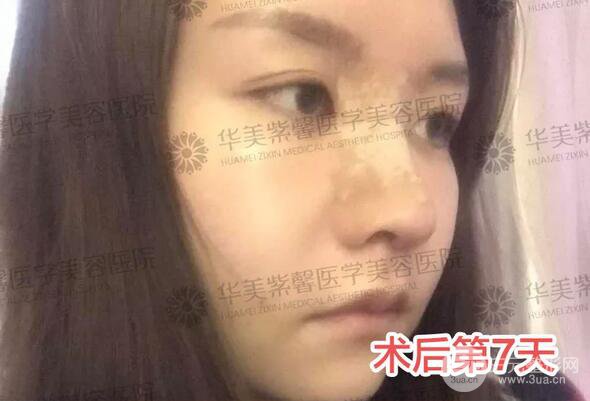 華美紫馨邱偉做的隆鼻術后10天驚人果分享！