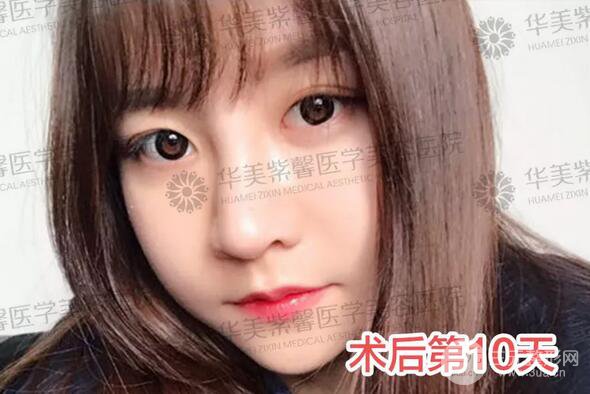 華美紫馨邱偉做的隆鼻術后10天驚人果分享！
