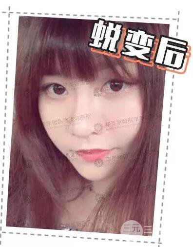 華美紫馨邱偉做的隆鼻術后10天驚人果分享！
