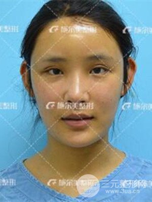 江蘇施爾美自體脂肪填充面部案例，前后對(duì)比圖分享