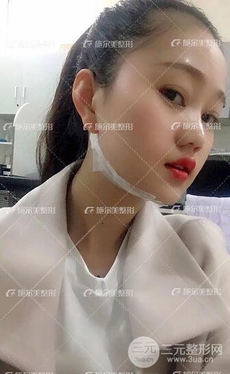 南京施爾美整形孫欣線D案例,重返17歲！