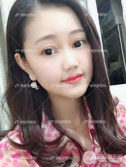 南京施爾美整形孫欣線D案例,重返17歲！