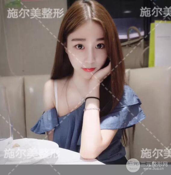 南京施爾美自體脂肪填充案例,拒絕“壽星公”！