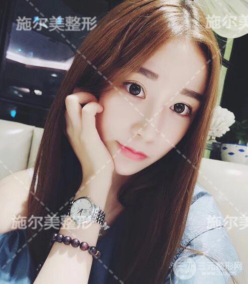 南京施爾美自體脂肪填充案例,拒絕“壽星公”！