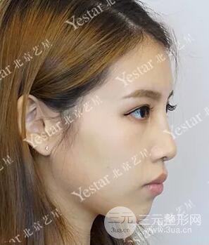 北京藝星仇侃敏耳軟骨隆鼻恢復(fù)過(guò)程|內(nèi)附前后對(duì)比圖