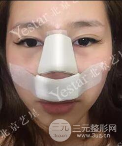 北京藝星仇侃敏耳軟骨隆鼻恢復(fù)過(guò)程|內(nèi)附前后對(duì)比圖