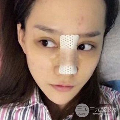 廣州韓妃李光琴隆鼻失敗修復(fù)前后對(duì)比圖分享！