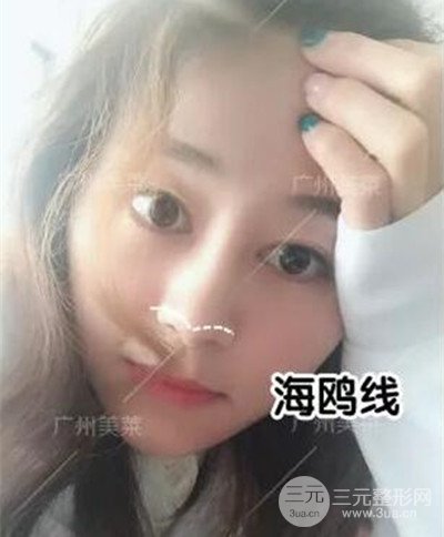 廣州美萊自體軟骨隆鼻案例前后對(duì)比圖分享!