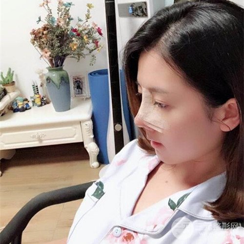 重慶五洲范文亮自體肋軟骨隆鼻案例前后對比圖分享~