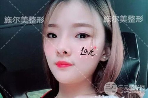 江蘇施爾美自體脂肪詳細(xì)部填充恢復(fù)記錄前后對(duì)比圖分享~