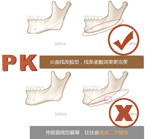 深圳非凡磨骨整形
