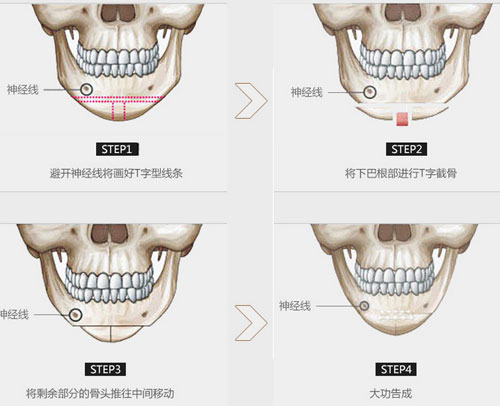 長曲線改臉型過程圖