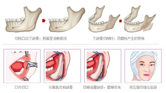 首爾麗格醫(yī)院下頜骨整形