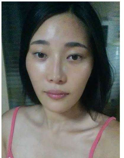 柳大烈給我做的改臉型手術 求圍觀!