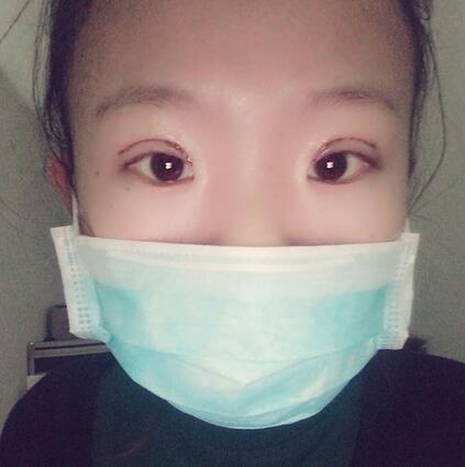割雙眼皮術(shù)后恢復(fù)過程 全切雙眼皮3個(gè)月