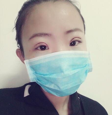 割雙眼皮術(shù)后恢復(fù)過程 全切雙眼皮3個(gè)月
