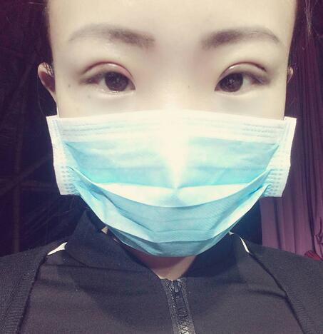 割雙眼皮術(shù)后恢復(fù)過程 全切雙眼皮3個(gè)月