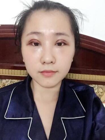 切的雙眼皮90天恢復(fù)過程圖