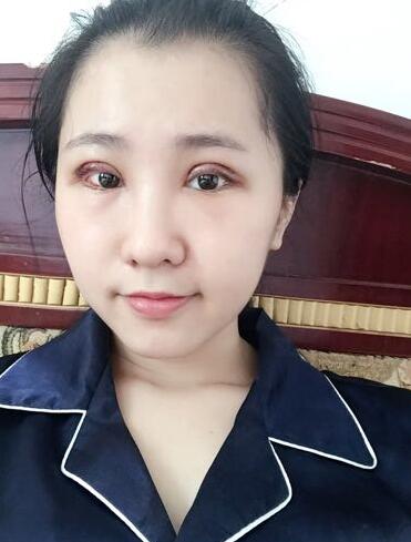 切的雙眼皮90天恢復(fù)過程圖