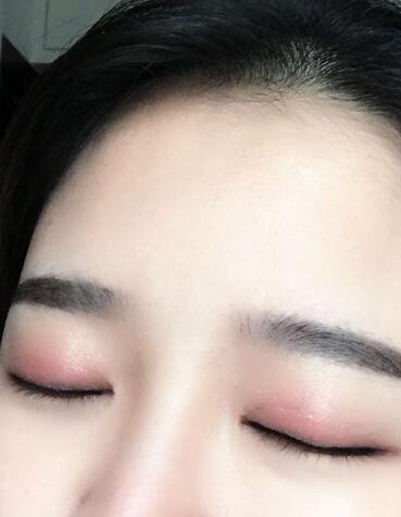 雙眼皮+開眼角3個月恢復(fù)過程圖