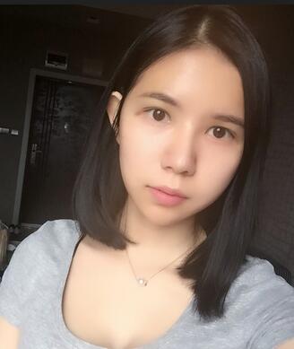 自體脂肪填充恢復日志 自體脂肪填充太陽穴+額頭