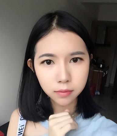 自體脂肪填充恢復日志 自體脂肪填充太陽穴+額頭