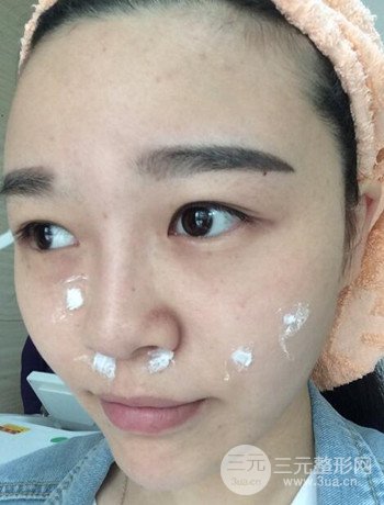 北京激光去雀斑真實(shí)案例分享，純素顏無濾鏡果圖